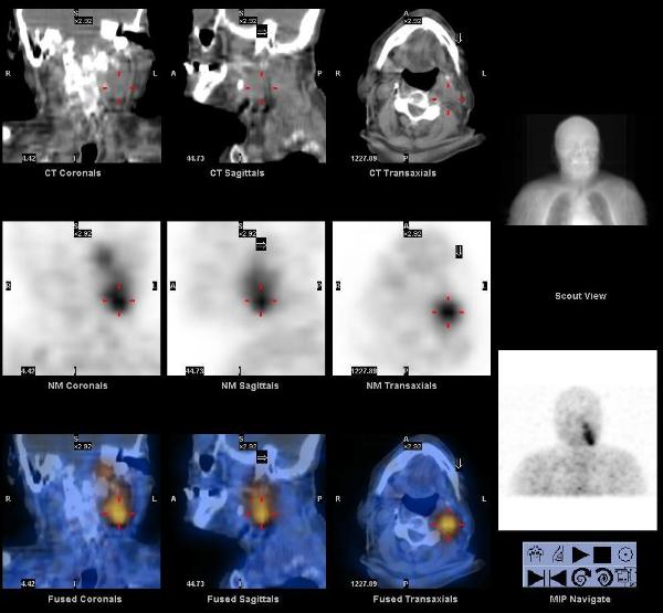 SPECT-CT-GLOMUS1-600x555