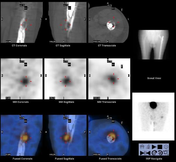 SPECT-CT-GLOMUS2-600x553